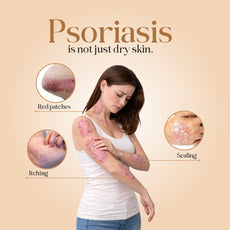 D-Scale – Psoriasis Capsules | Bottle of 60 Cap