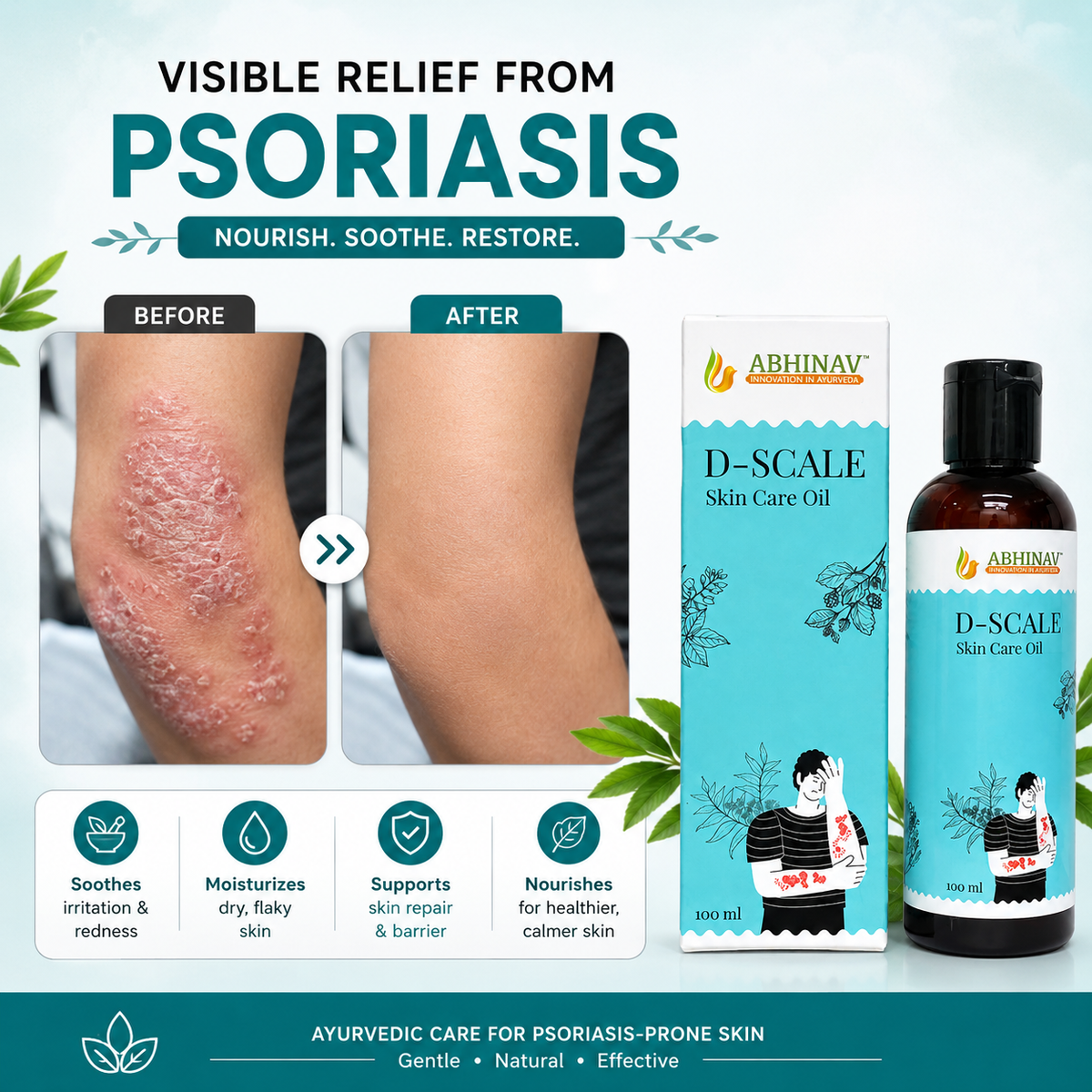 D-Scale | Psoriasis skin Care Oil  – Bottle of 100gm