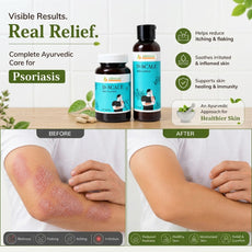 D-Scale | Psoriasis Combo Kit – Capsules + Lotion