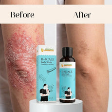 D-Scale | Psoriasis Body Wash – Bottle of 100gm