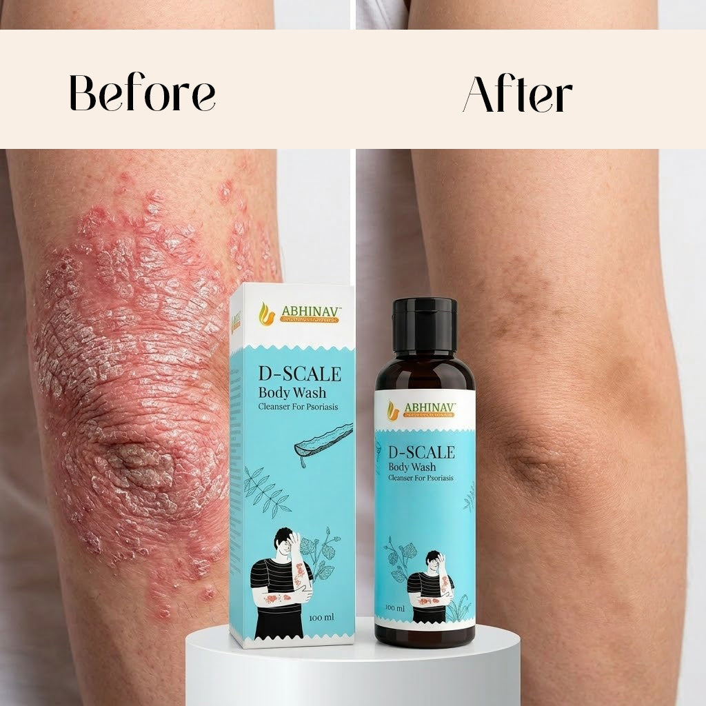 D-Scale | Psoriasis Body Wash – Bottle of 100gm