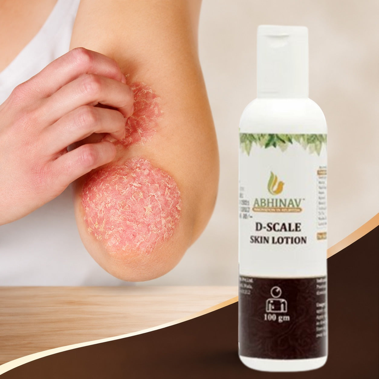 D-Scale | Psoriasis Lotion – Bottle of 100gm