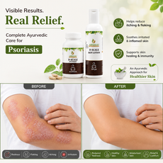 D-Scale | Psoriasis Combo Kit – Capsules + Lotion