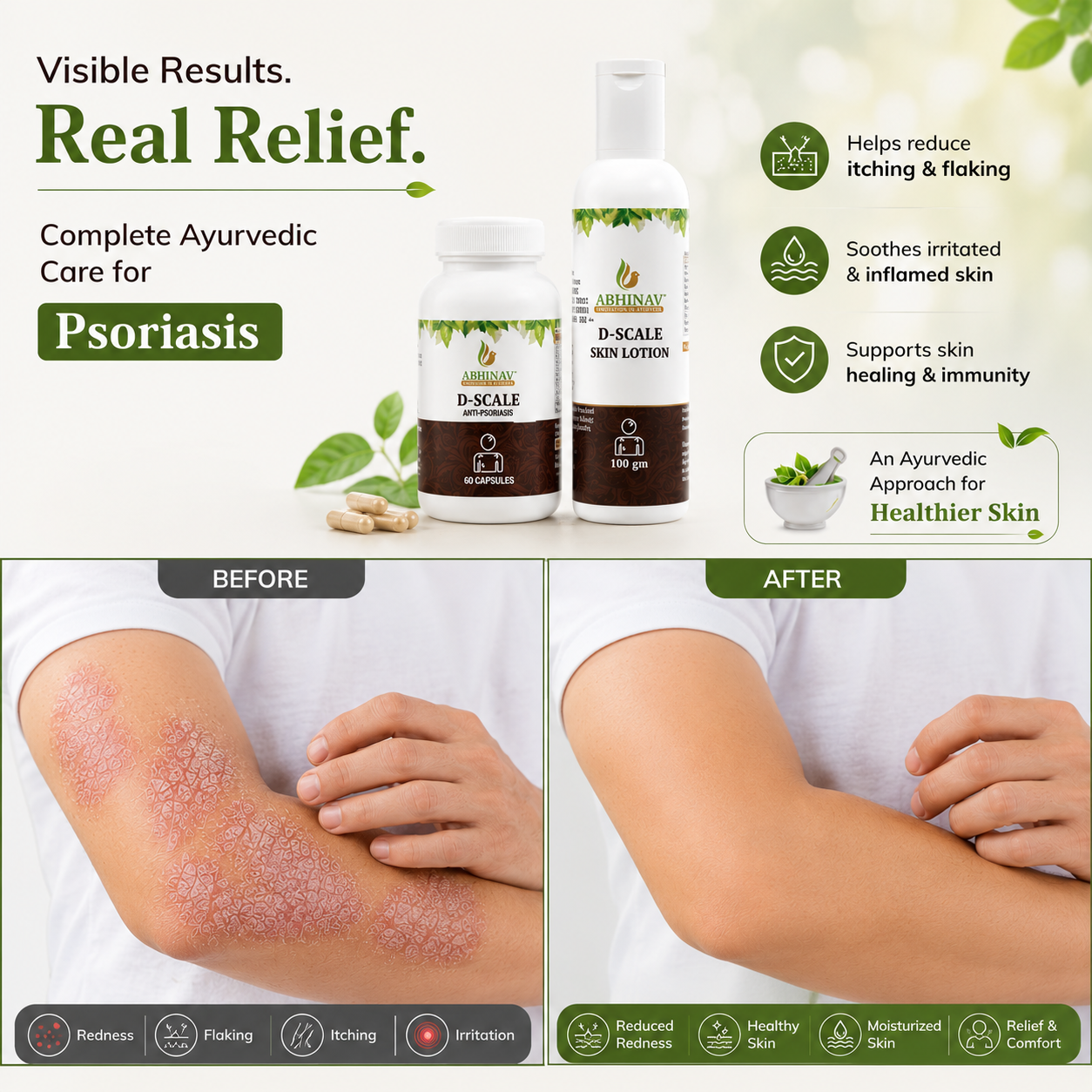 D-Scale | Psoriasis Combo Kit – Capsules + Lotion