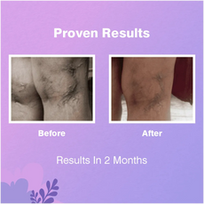 Var-Erase | Ayurvedic Varicose Veins Lotion – 100 gm