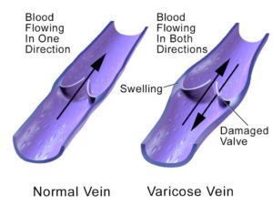 Normal vein vs varicose vein