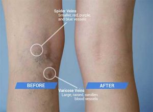 varicose veins before and after treatment