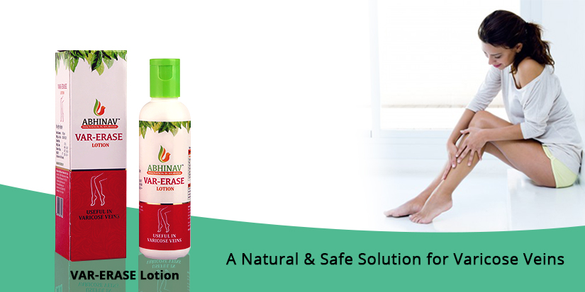 A-natural-safe-solution-for-varicose-veins