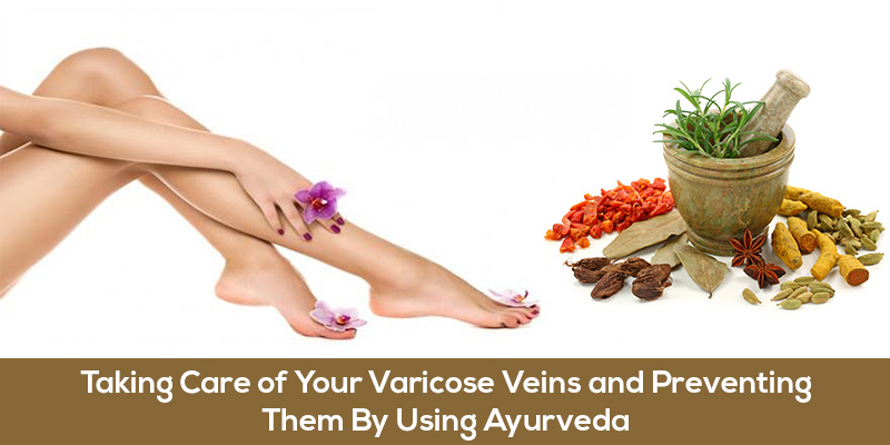 Taking Care of Your Varicose Veins and Preventing Them By Using Ayurveda -  Abhinav Health Care