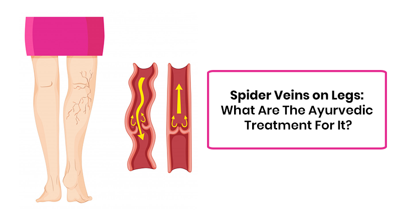 Spider Veins on Legs What Are The Ayurvedic Treatment For It