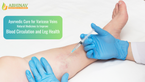 Varicose veins treatment on leg using natural therapy