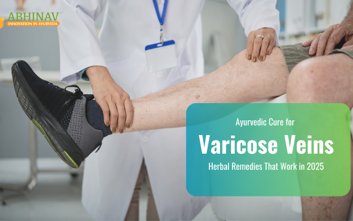 Ayurvedic Cure for Varicose Veins