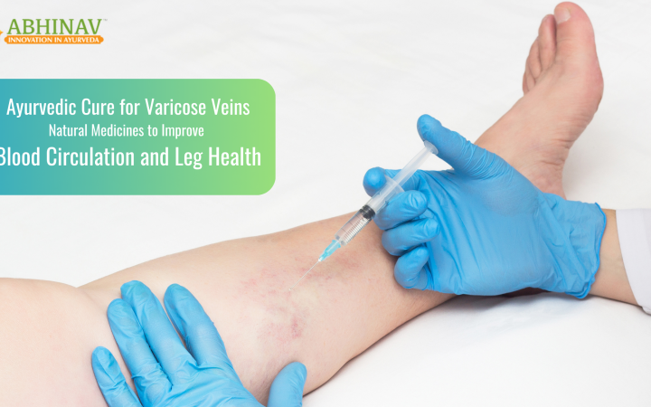 Varicose veins treatment on leg using natural therapy